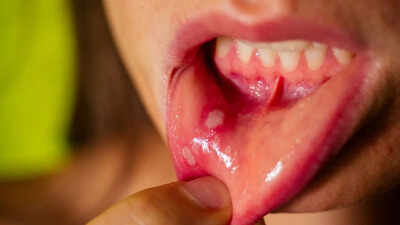 Persistent mouth ulcers or a changing voice? Doctor says these common symptoms may signal something serious