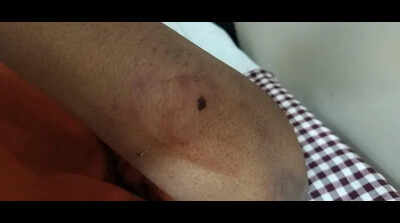 Census worker, NMC staff among 3 bitten by dog in Sadar
