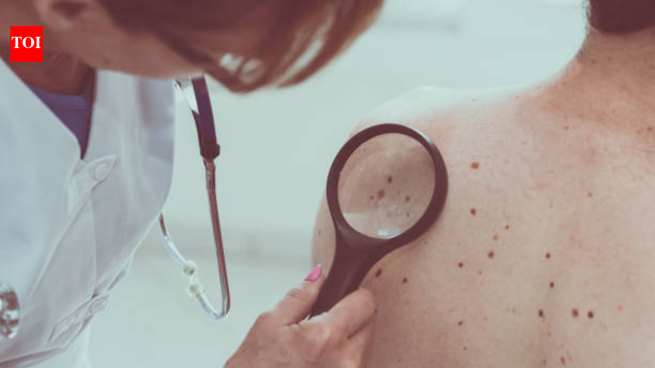 Melanoma cases hit record high in the UK: What it is and how to prevent it