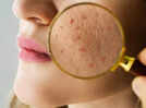 Can&rsquo;t get rid of dark spots, pigmentation, uneven skin tone this summer? Dermatologists reveal treatments that deliver visible results against sun damage
