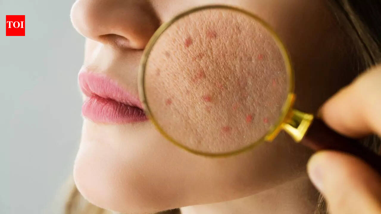 Can't get rid of dark spots, pigmentation this summer? Dermatologists reveal treatments that work