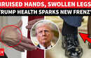 Trump Health SHOCKER: &lsquo;Hand Bruising, Leg Swelling&rsquo; Back In Focus Amid White House Clean Chit
