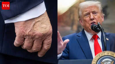 ‘What happened to his hands?’ Donald Trump’s annual physical results offer explanation for his ‘bruises’