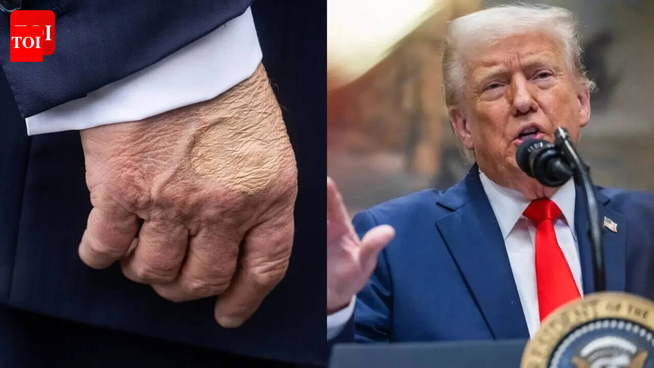 ‘What happened to his hands?’ Donald Trump’s annual physical results offer explanation for his ‘bruises’