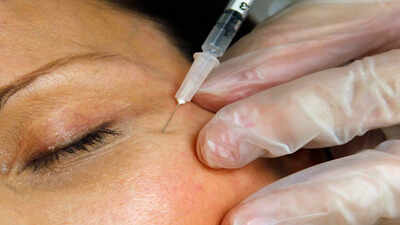In 1987, doctors observed wrinkle changes in eye patients, marking Botox’s entry into cosmetic use