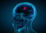 World Brain Tumour Day: Can your lifestyle really influence brain health and tumour risk?