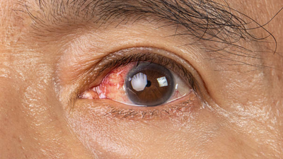  What causes the 'sunburn of the eyes' and how to stay safe