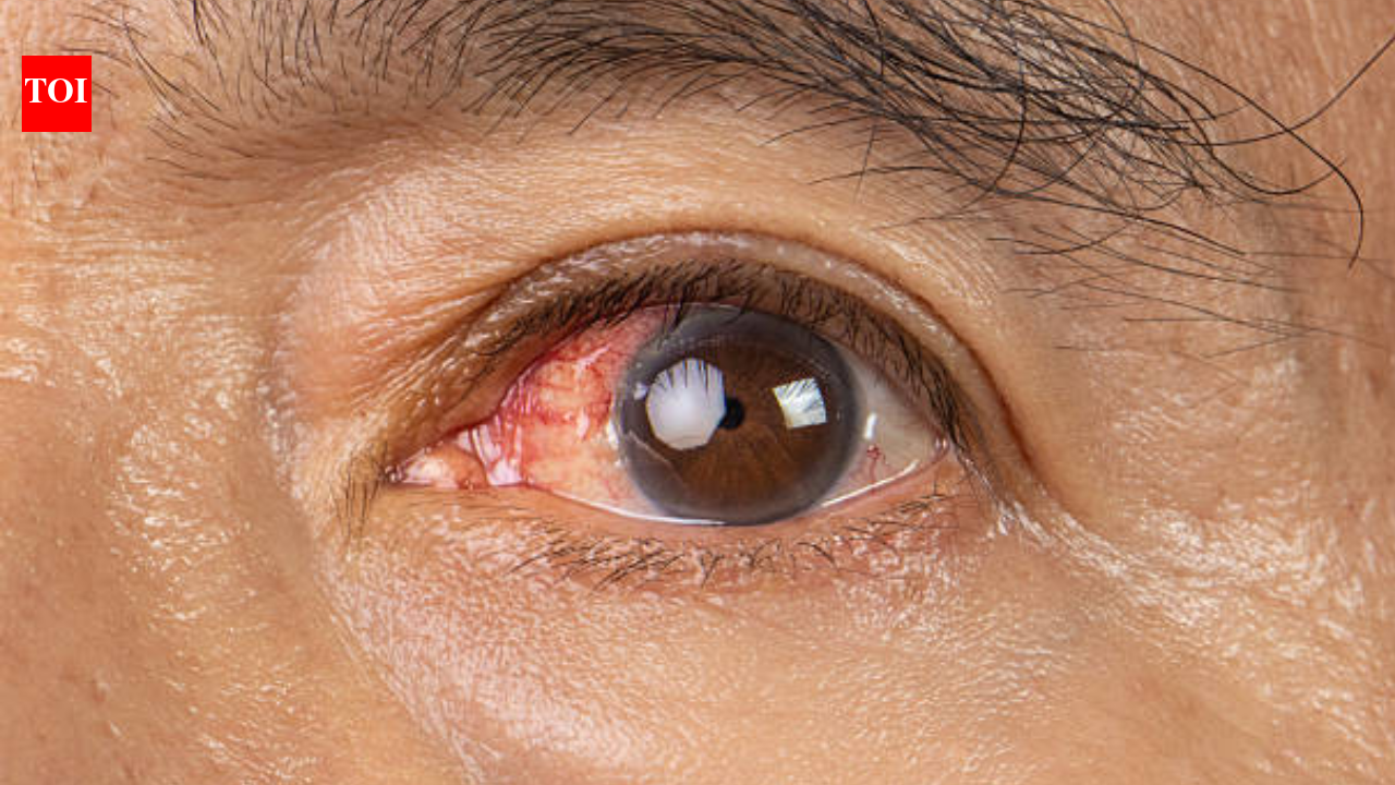 Photokeratitis: What causes the 'sunburn of the eyes' and how to stay safe