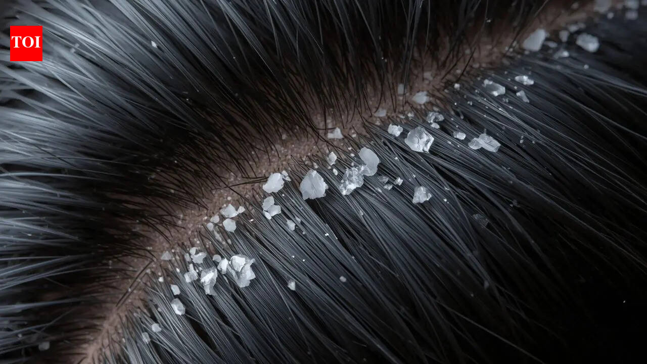 Why your dandruff keeps coming back? Understanding the science of recurring scalp conditions