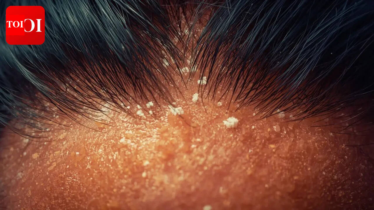 Reading the label right: The anti-dandruff ingredients that actually matter