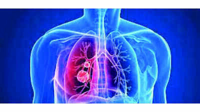 Hyd student develops AI model for early lung cancer detection