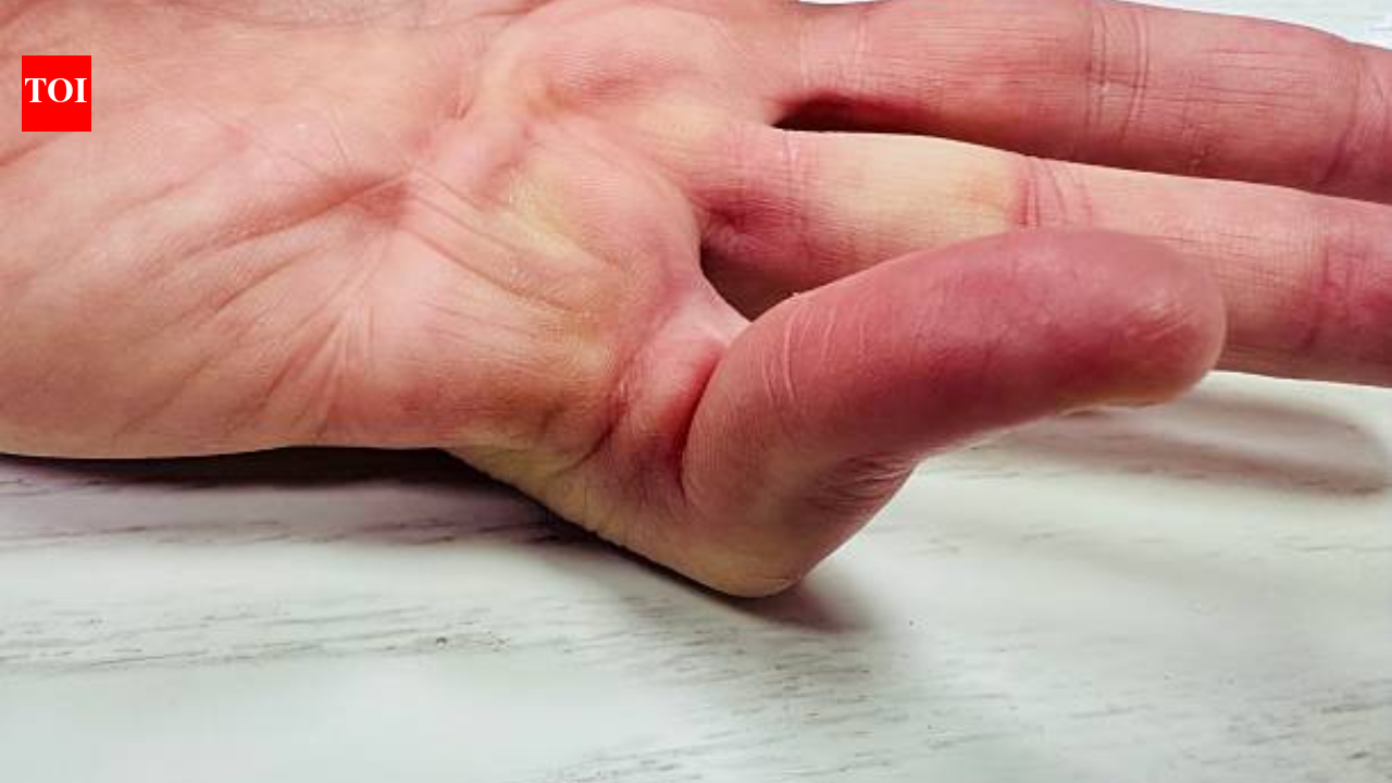 Viking disease: Scientists say this hand condition may be inherited ...