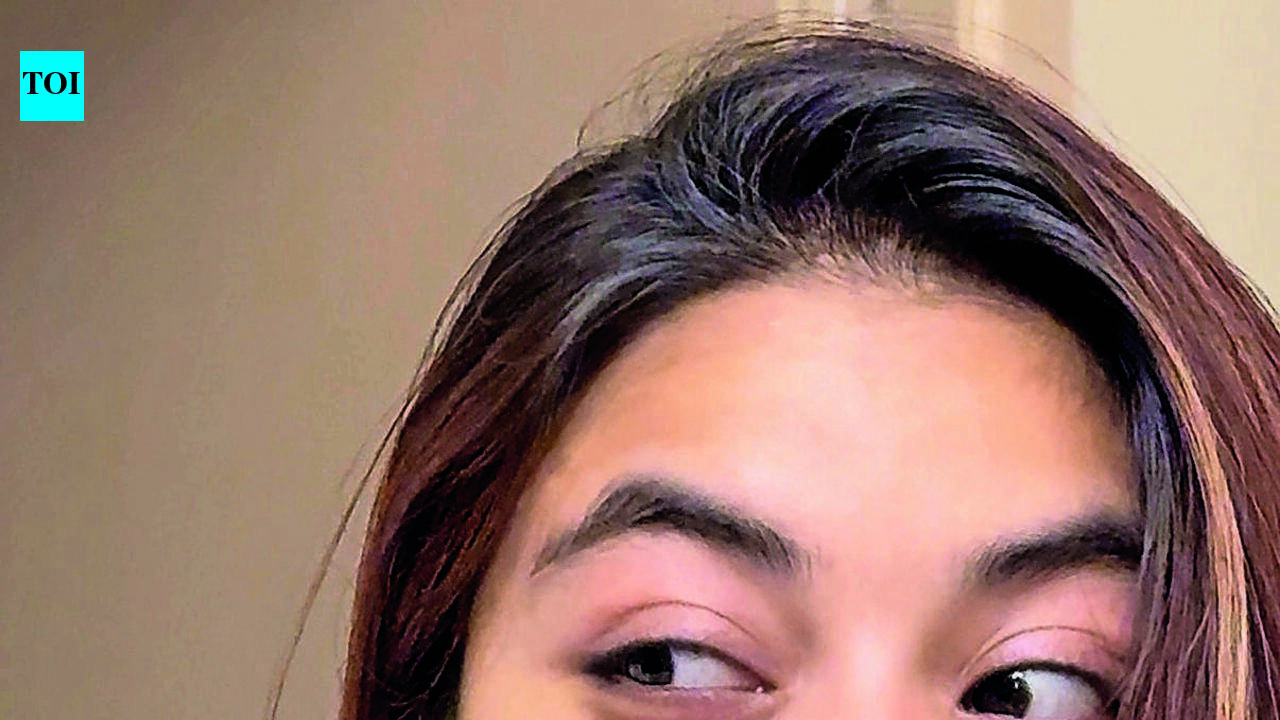 Vitiligo Awareness Grows in Tamil Nadu, But Stigma and Myths Persist