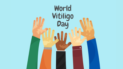  Dermatologist urges people to look beyond the skin this World Vitiligo Day