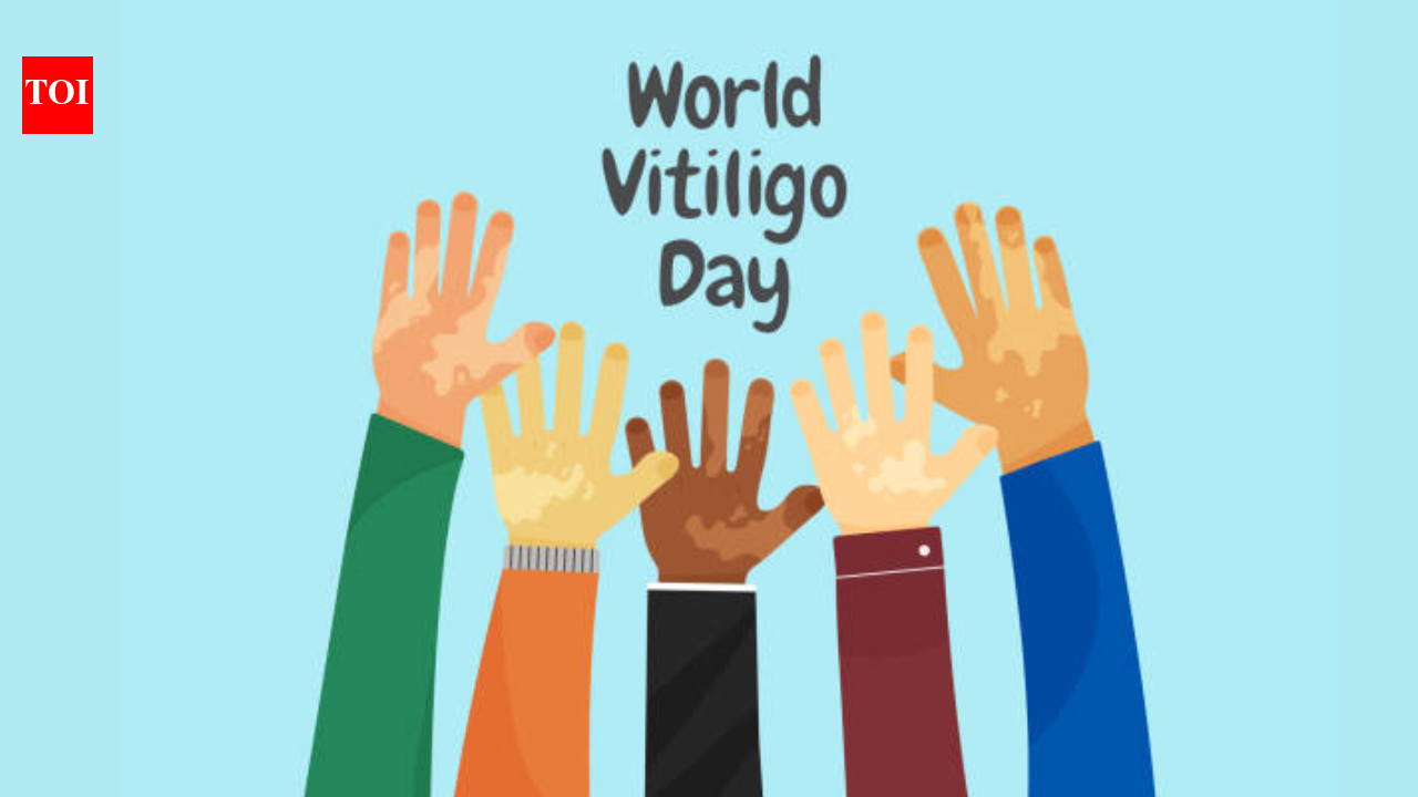Vitiligo is not contagious: Dermatologist urges people to look beyond the skin this World Vitiligo Day