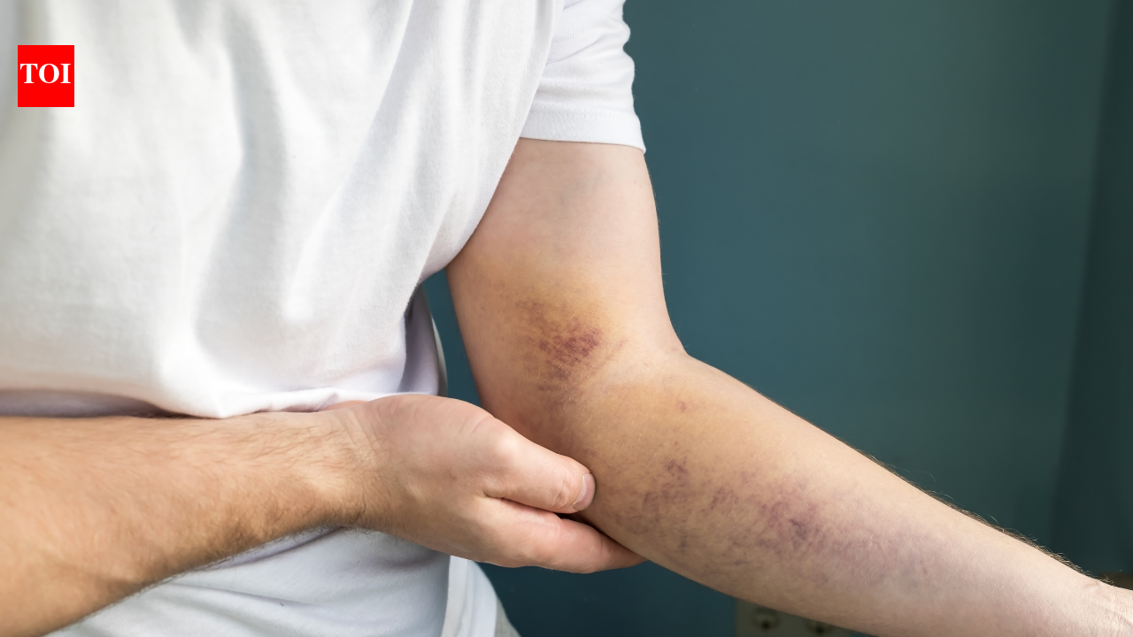 Tired all the time and bruising easily? It may be more than just ageing, doctors warn