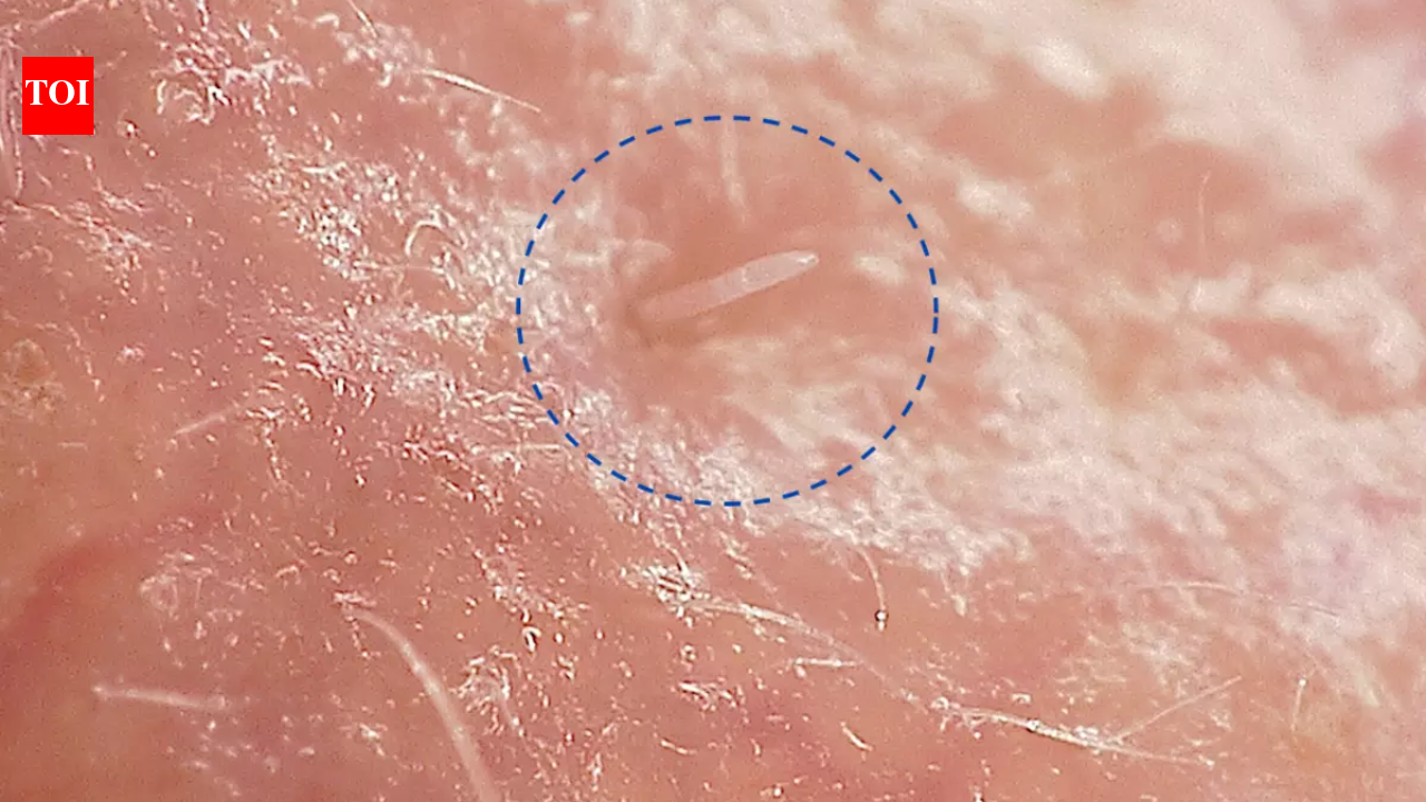This microscopic creature has lived on your face for years; now scientists say it's almost out of genes