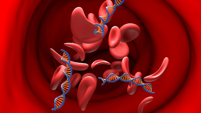 sickle-cell-disease-3.jpg