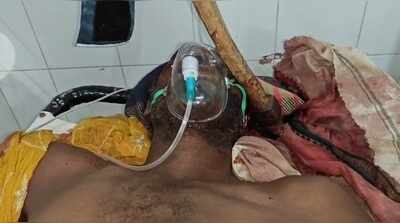 Doctors remove axe lodged in man’s skull