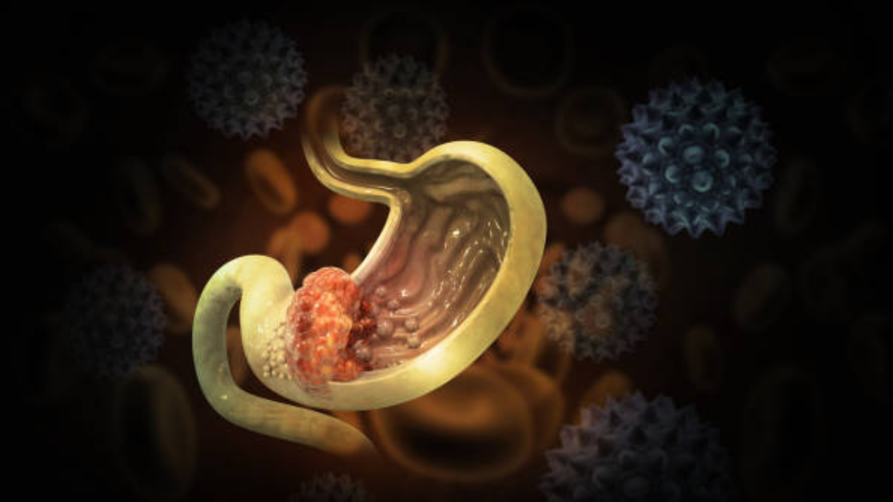 Persistent gas turned out to be a 30-cm rare cancer occupying most of the abdomen: Case of a 72-year-old woman from Mumbai
