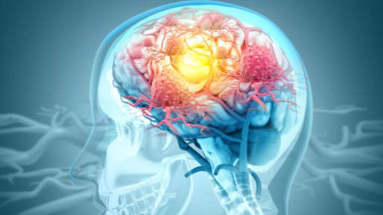 After 20 patients in trials, as Elon Musk's Neuralink awaits FDA approval; China completes world’s first commercial brain-computer interface implant