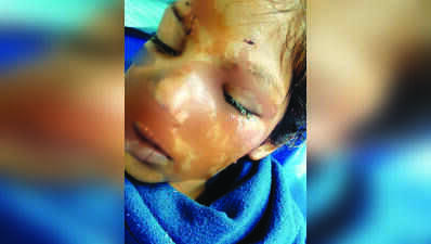 Dogs maul 10-year-old girl in Amravati, she’s battling for life