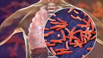 Aggressive screening helps TN detect 48,469 TB cases