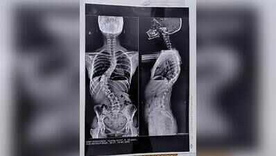 Ghaziabad teen walks straight after surgery in Gurgaon corrects severe spinal curve