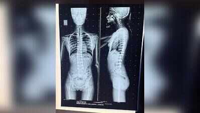 Ghaziabad teen walks straight after surgery in Gurgaon corrects severe spinal curve