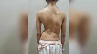 Ghaziabad teen walks straight after surgery in Gurgaon corrects severe spinal curve