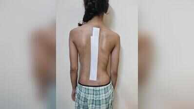 Ghaziabad teen walks straight after surgery in Gurgaon corrects severe spinal curve