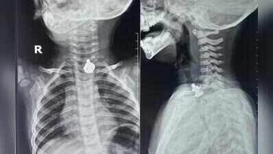Docs remove nut and bolt from toddler’s food pipe four hours after he swallows it