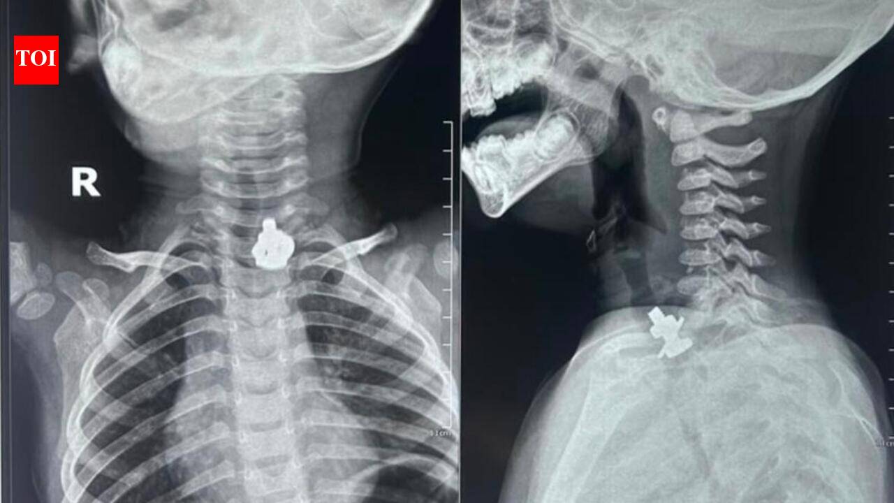 Docs remove nut and bolt from toddler's food pipe four hours after he swallows it