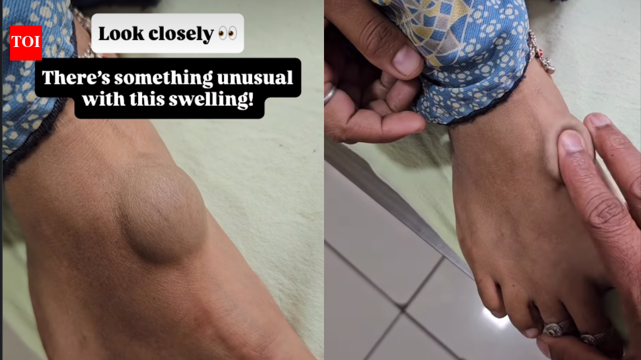 Don't ignore that soft lump or birthmark: Doctor warns it could be a serious vascular malformation