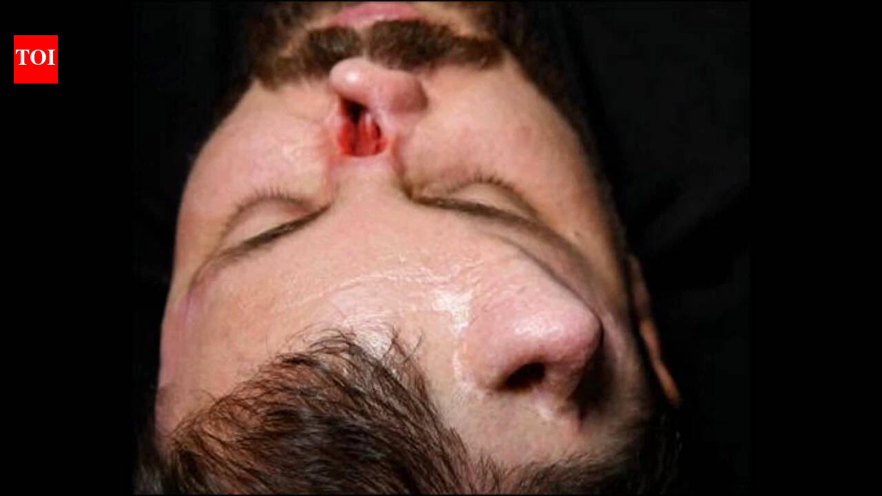 Iraqi surgeon grows nose on patient's forehead in rare reconstruction surgery to correct facial damage in high-voltage electrical accident