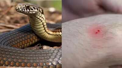 Snake bites MP woman 5 times in 2 minutes; 35 injections save her life