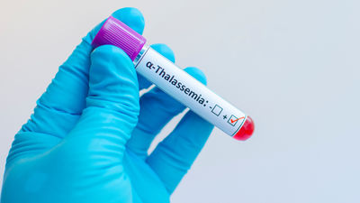 Bone marrow transplant is not a last resort for thalassemia: Doctors reveal the myths, facts and realities families often overlook