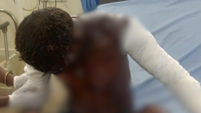 9  injured after furnace explosion at private steel plant in Jharkhand