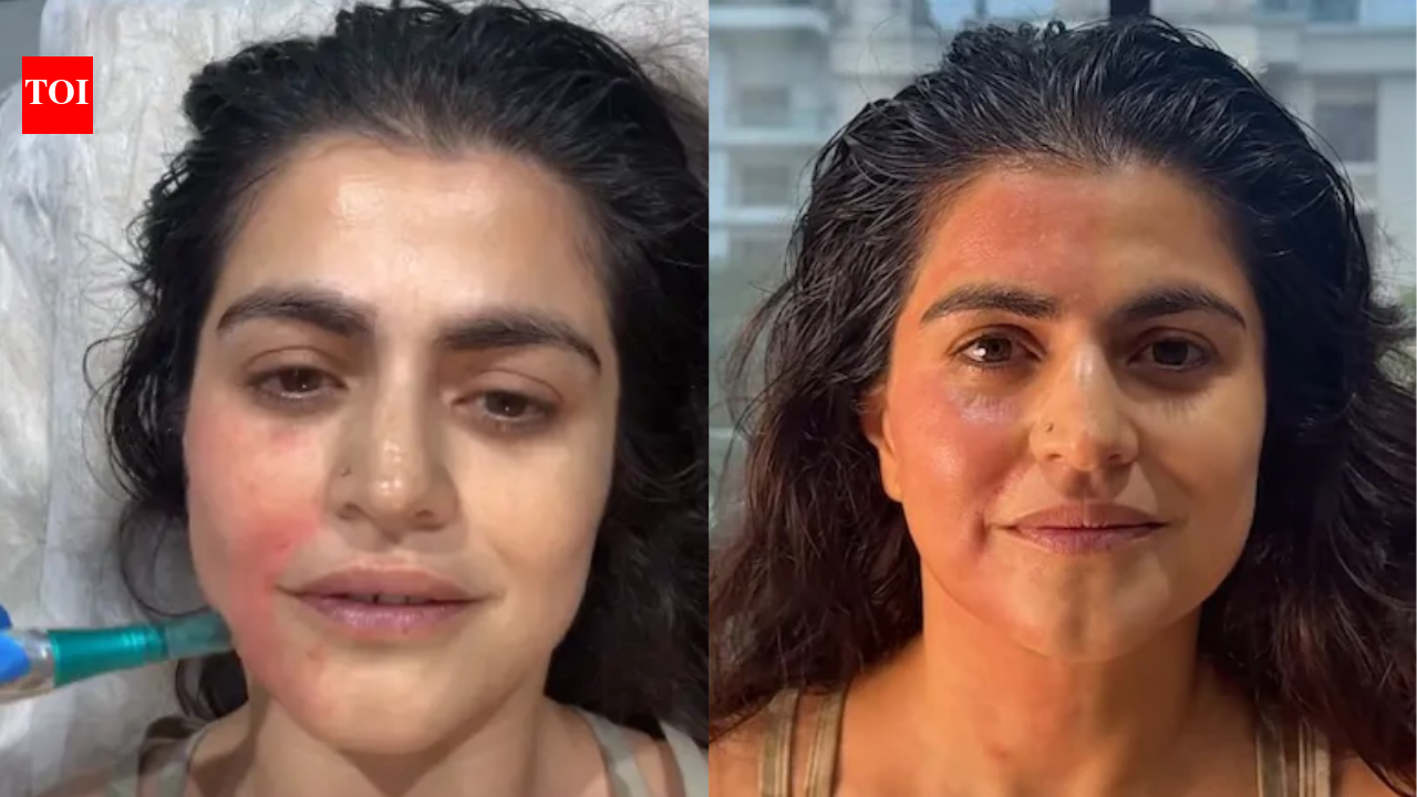 Travel vlogger Shenaz Treasury gets a vampire facial: Know its benefits, risks, and cost in India?