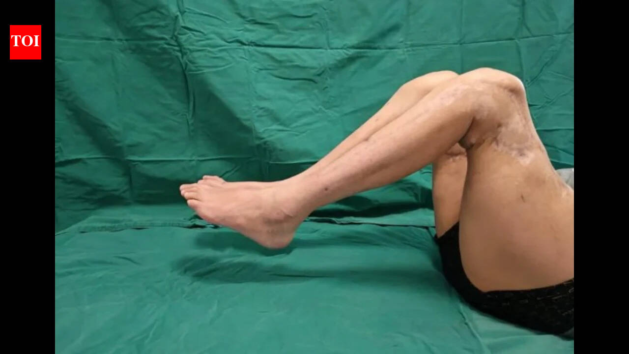 Chinese doctors claim first-ever successful double thigh replantation; factory worker starts walking again after losing both legs