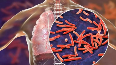 Over 87,600 TB cases detected in Bihar during 6-week statewide screening drive