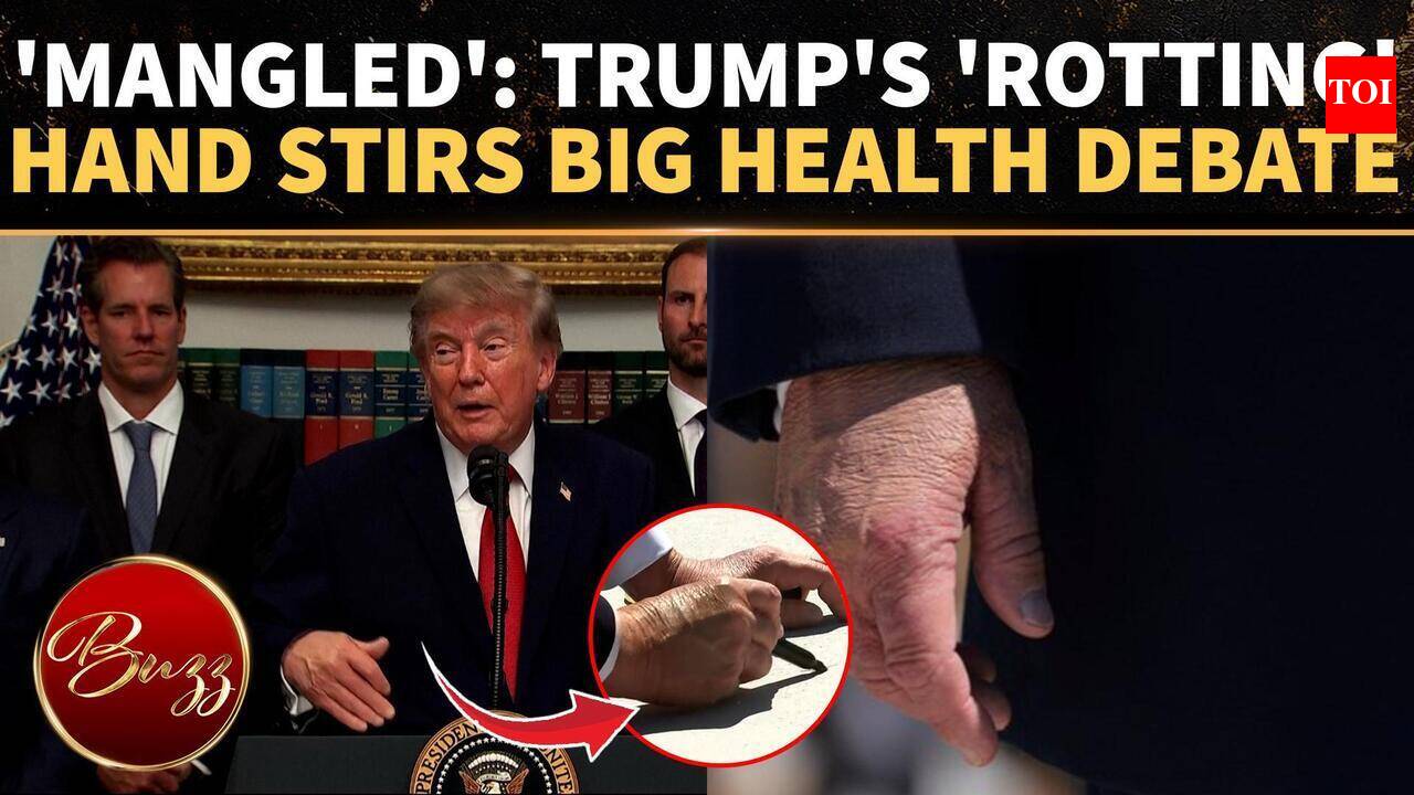 Donald Trump’s Swollen Hand Goes Viral; Fresh Health Questions Emerge Over New White House Photos