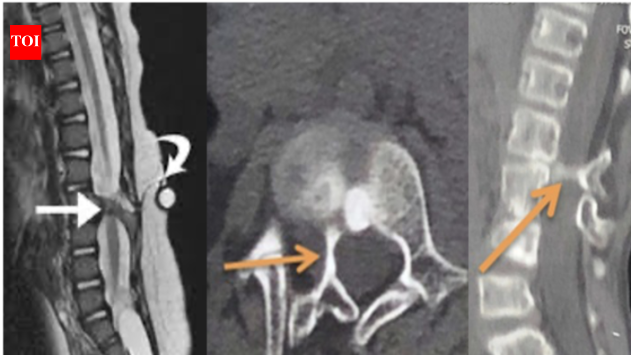 SGPGI develops safety device for complex paediatric spinal surgeries