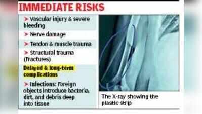Docs extract 6-inch plastic strip from 59-year-old woman’s arm