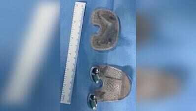 No cement: KEM tries new-age knee implant for first time in Mumbai