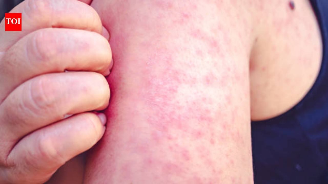 The silent window of measles: How someone can spread the virus before the rash appears