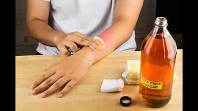 Is it safe to remove moles with apple cider vinegar?