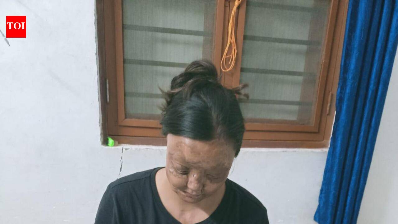 Decade after acid attack, woman cracks 2 govt job exams