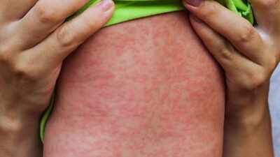 Measles outbreak in Pennsylvania: 40-year-old woman dies of complications from measles; early signs, risk factors, prevention, and treatment explained