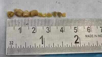 10 salivary stones removed from teen’s duct through mouth